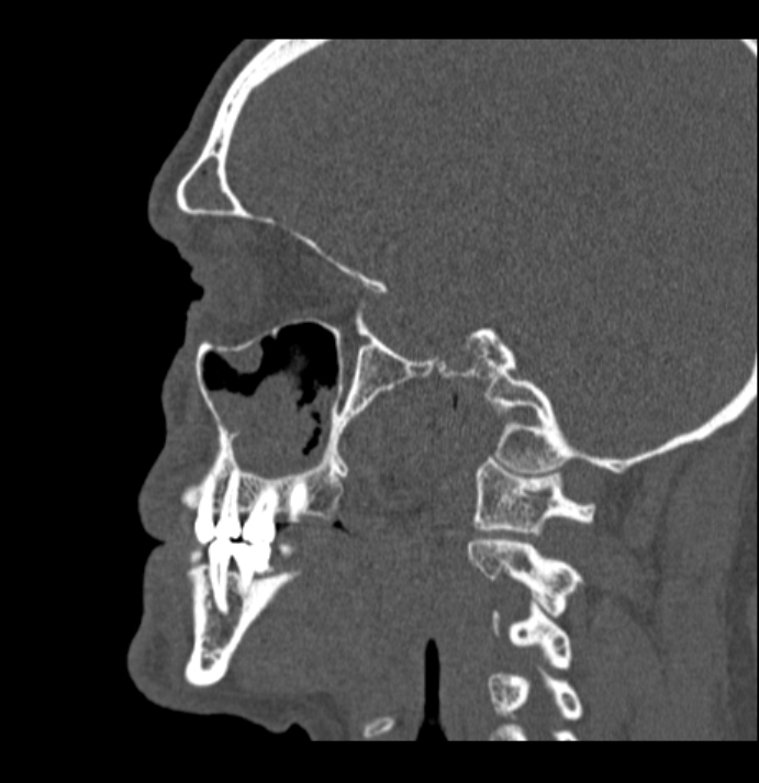 Antrochoanal polyp (Radiopaedia 79011-92169 Sagittal bone window 9).jpg