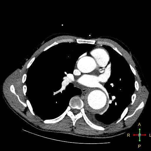 File:Aortic aneurysm and penetrating ulcer (Radiopaedia 23590-23704 A 18).jpg