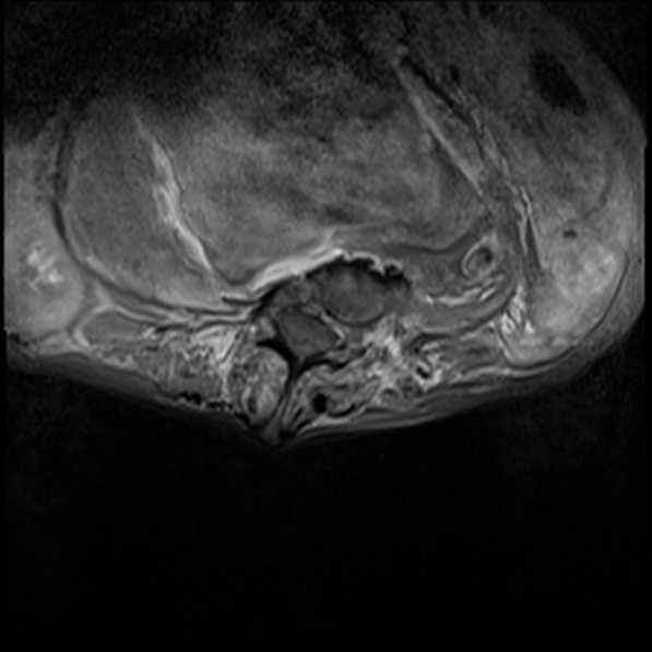File:Aortic aneurysm with spinal destruction (Radiopaedia 42301-45409 Axial T1 fat sat 17).jpg