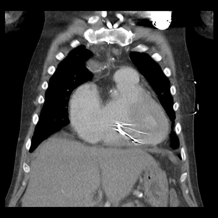 Aortic arch graft infection (FDG PET-CT) (Radiopaedia 71975-82437 Coronal 20).jpg