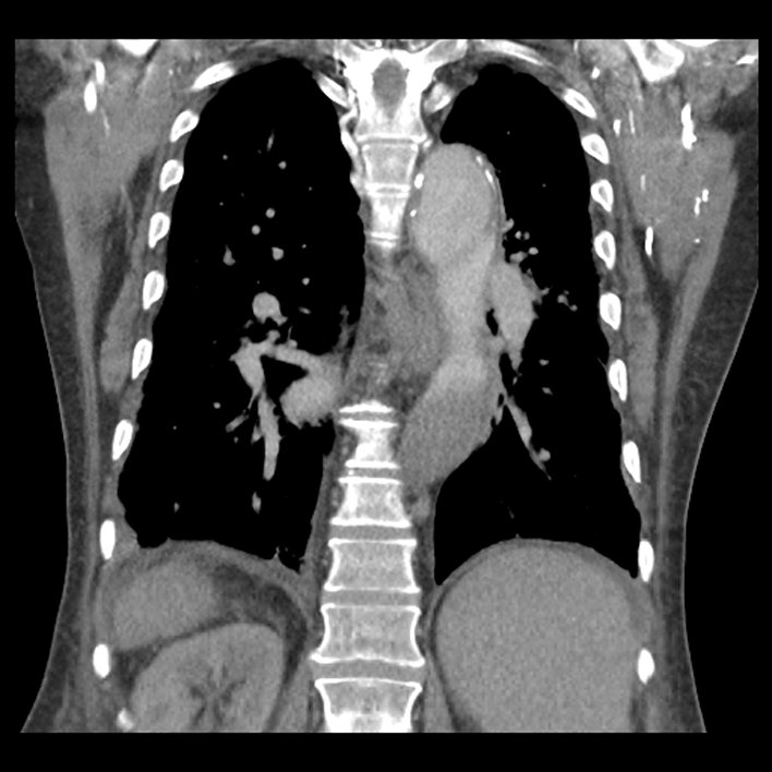 Aortic arch graft infection (FDG PET-CT) (Radiopaedia 71975-82437 Coronal 43).jpg