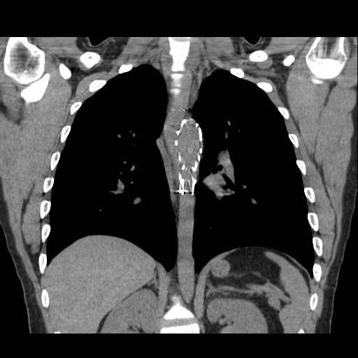 File:Aortic arch stent (Radiopaedia 30030-30595 Coronal non-contrast 18).jpg