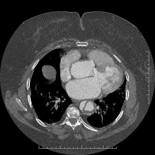 Aortic dissection- Stanford A (Radiopaedia 35729-37268 A 58).jpg