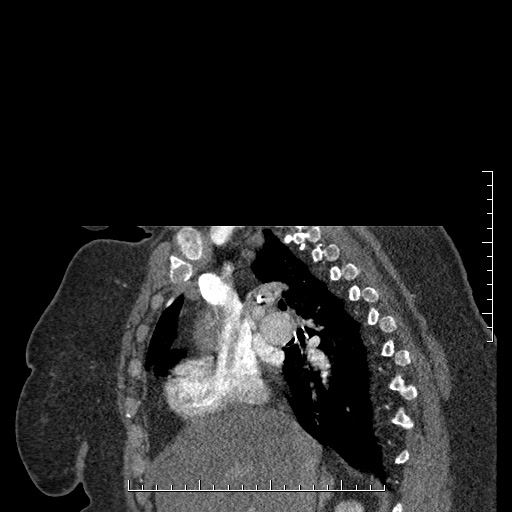 File:Aortic dissection- Stanford A (Radiopaedia 35729-37268 D 43).jpg