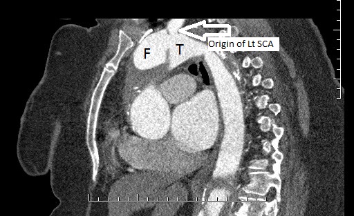 File:Aortic dissection- Stanford A (Radiopaedia 35729-39076 Multiple Annotated 3).jpg