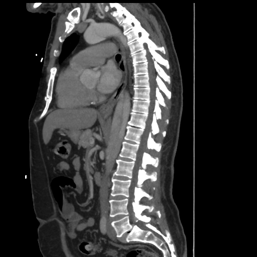 File:Aortic dissection- Stanford A (Radiopaedia 37759-39664 Sagittal C+ delayed 18).png