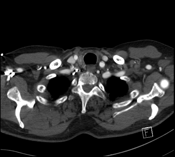 Aortic dissection (CTPA) (Radiopaedia 75506-86750 A 7).jpg