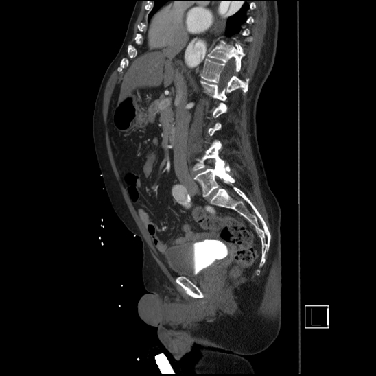 Aortic dissection (CTPA) (Radiopaedia 75506-86750 G 51).jpg