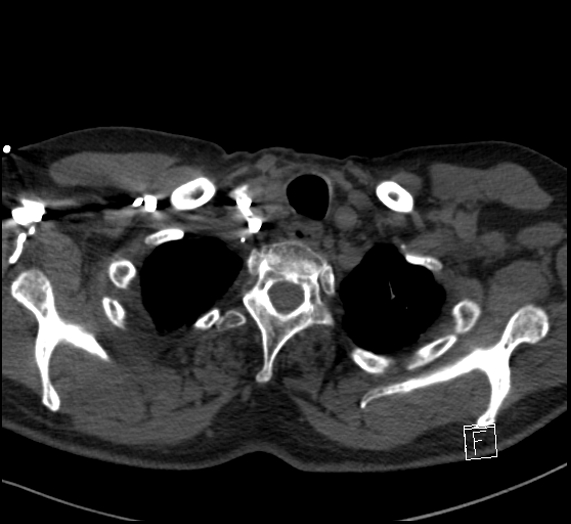 Aortic dissection (CTPA) (Radiopaedia 75506-86751 Axial C+ CTPA 13).jpg