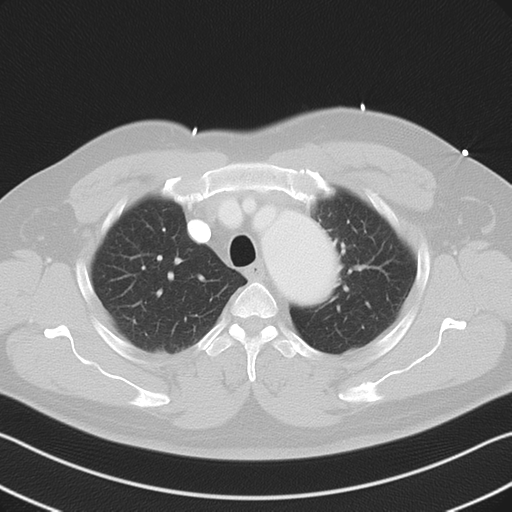 File:Aortic dissection (Radiopaedia 50763-56234 Axial lung window 20).png