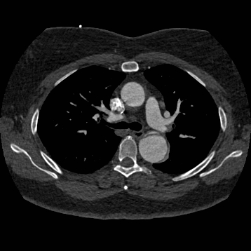 File:Aortic dissection (Radiopaedia 57969-64959 A 124).jpg