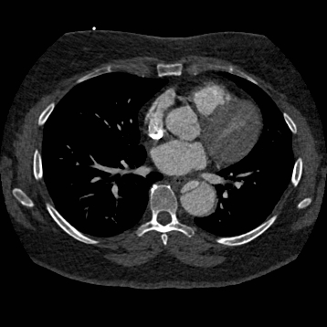 Aortic dissection (Radiopaedia 57969-64959 A 176).jpg