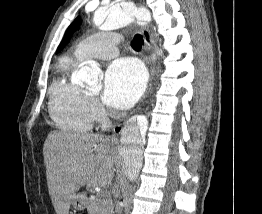 File:Aortic dissection - Stanford A -DeBakey I (Radiopaedia 28339-28587 C 31).jpg