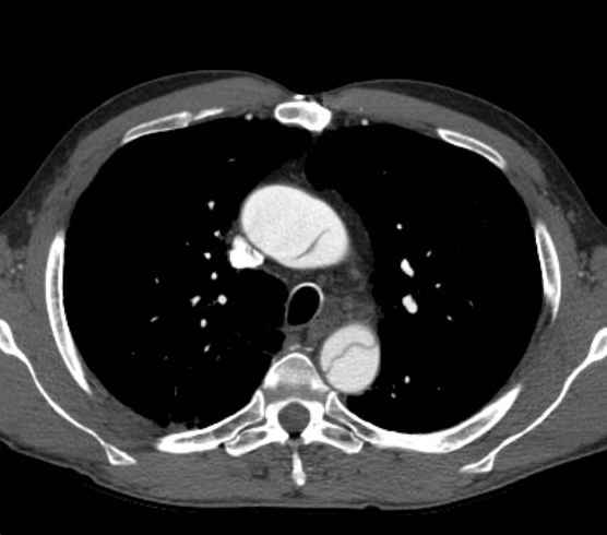 File:Aortic dissection - Stanford type B (Radiopaedia 73648-84437 A 30).jpg