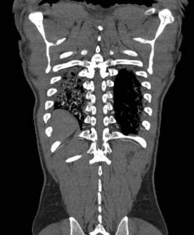 File:Aortic dissection - Stanford type B (Radiopaedia 73648-84437 B 103).jpg