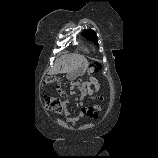 File:Aortic dissection - Stanford type B (Radiopaedia 88281-104910 B 8).jpg