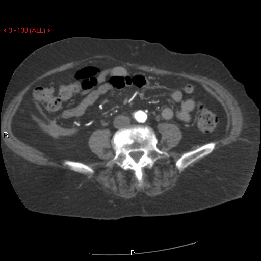 File:Aortic intramural hematoma (Radiopaedia 27746-28001 A 138).jpg