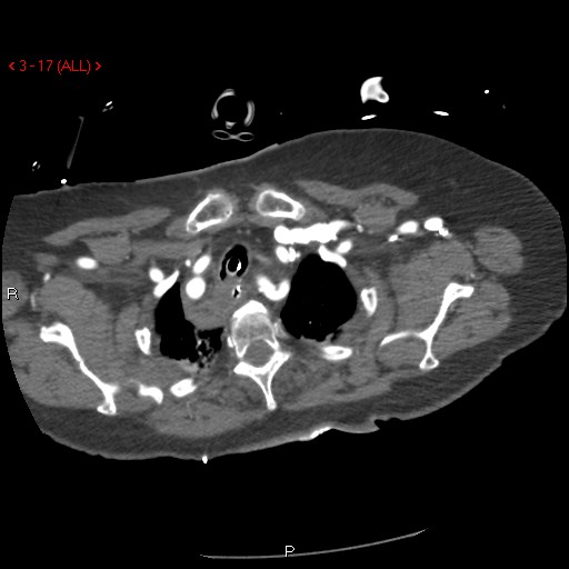 Aortic intramural hematoma (Radiopaedia 27746-28001 A 17).jpg