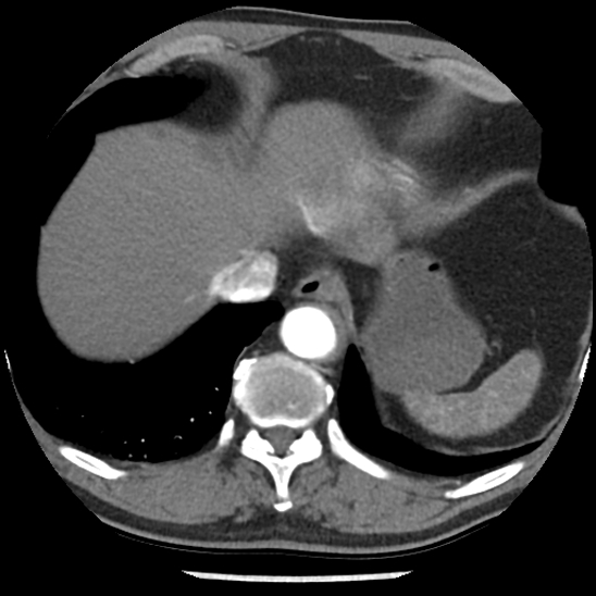 Aortic intramural hematoma (type B) (Radiopaedia 79323-92387 B 46).jpg