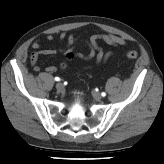 File:Aortic intramural hematoma (type B) (Radiopaedia 79323-92387 B 96).jpg