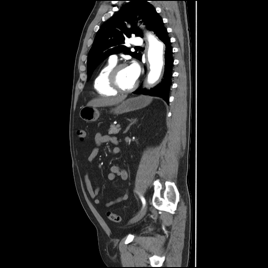 Aortic intramural hematoma (type B) (Radiopaedia 79323-92387 H 34).jpg