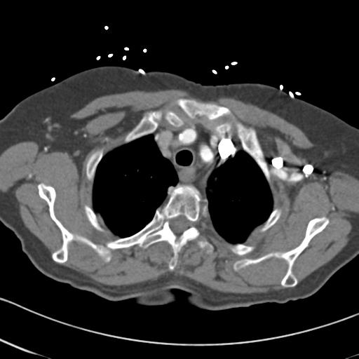 Aortic intramural hematoma from penetrating atherosclerotic ulcer (Radiopaedia 31137-31836 A 12).jpg