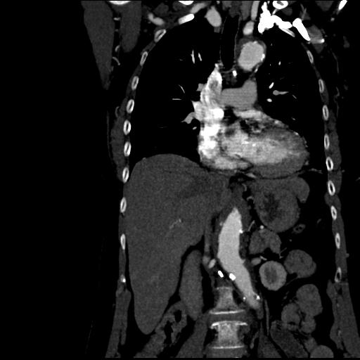 Aortic intramural hematoma from penetrating atherosclerotic ulcer (Radiopaedia 31137-31836 C 30).jpg