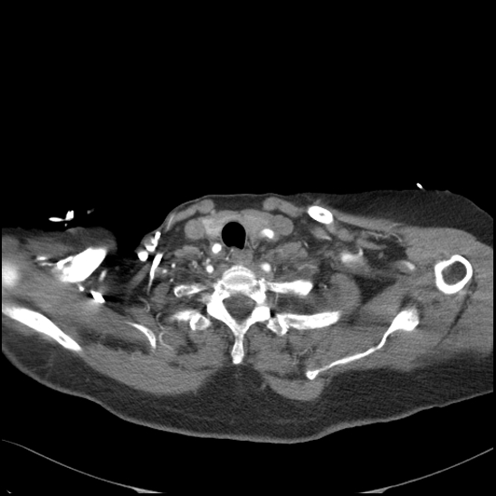 File:Aortic intramural hematoma with dissection and intramural blood pool (Radiopaedia 77373-89491 B 24).jpg