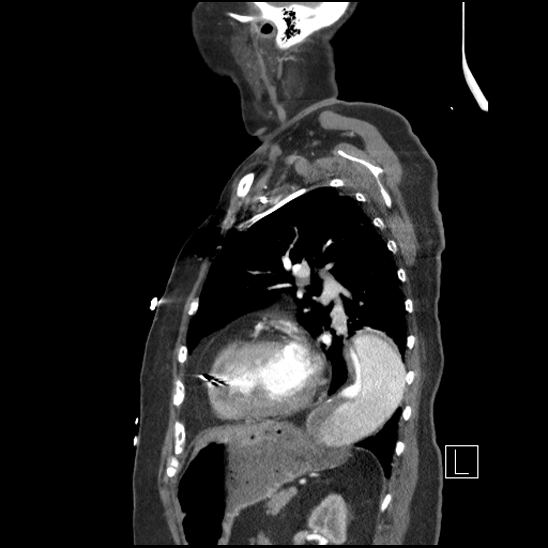 Aortic intramural hematoma with dissection and intramural blood pool (Radiopaedia 77373-89491 D 61).jpg
