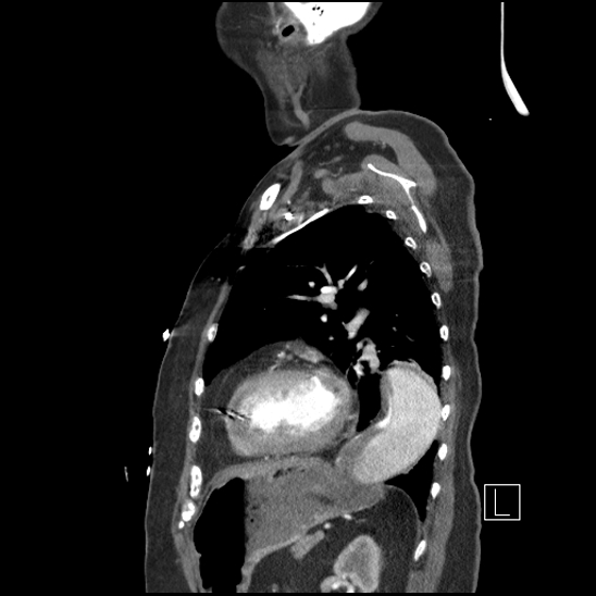 Aortic intramural hematoma with dissection and intramural blood pool (Radiopaedia 77373-89491 D 62).jpg