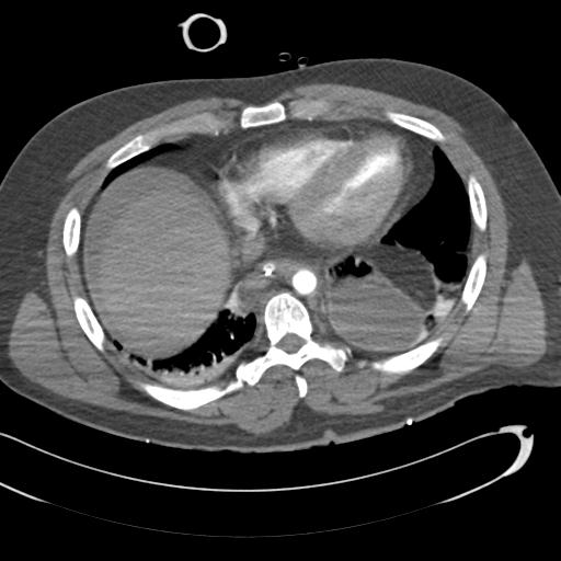 Aortic transection, diaphragmatic rupture and hemoperitoneum in a complex multitrauma patient (Radiopaedia 31701-32622 A 61).jpg