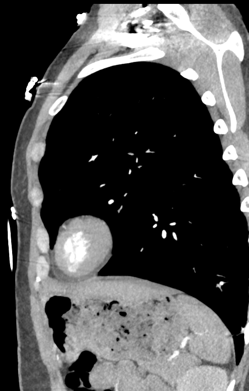 Aortic valve non-coronary cusp thrombus (Radiopaedia 55661-62189 C+ arterial phase 3).png
