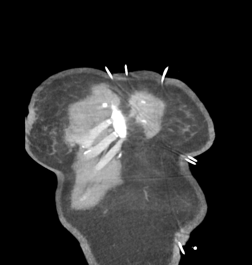 File:Aortic valve non-coronary cusp thrombus (Radiopaedia 55661-62189 C 7).png
