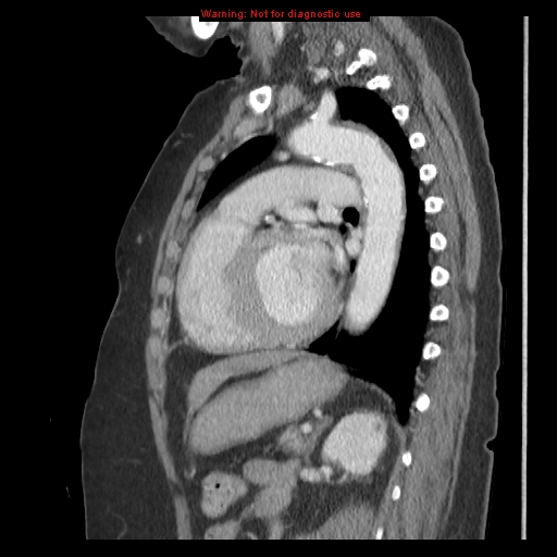 File:Aortic valve stenosis (Radiopaedia 14480-14423 B 10).jpg