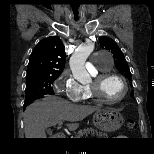 File:Aorto-coronary bypass graft aneurysms (Radiopaedia 40562-43157 B 16).png
