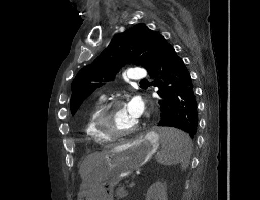 Aortoesophageal fistula with endovascular repair (Radiopaedia 73781-84592 Sagittal C+ CTPA 128).jpg