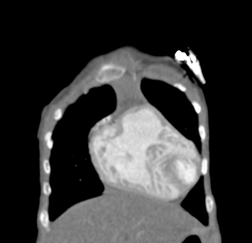File:Aortopulmonary window, interrupted aortic arch and large PDA giving the descending aorta (Radiopaedia 35573-37074 D 8).jpg