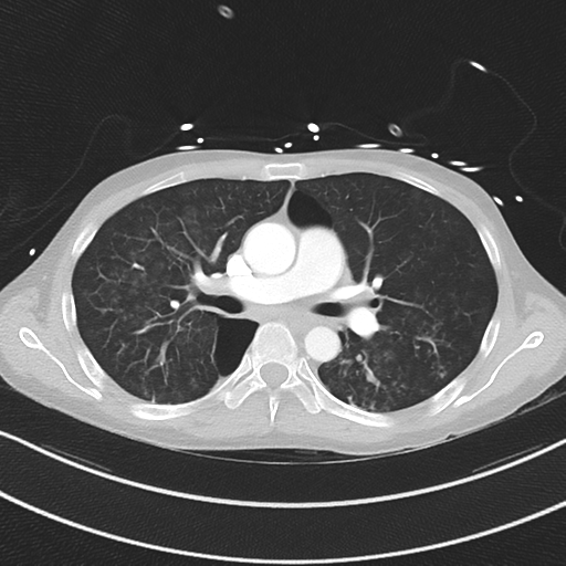 Apical bullous disease in a heavy smoker (Radiopaedia 33067-34092 Axial lung window 29).png