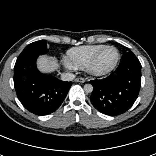 Apical lung mass mimic - neurogenic tumor (Radiopaedia 59918-67521 A 61).jpg