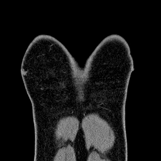 Apical lung mass mimic - neurogenic tumor (Radiopaedia 59918-67521 B 28).jpg