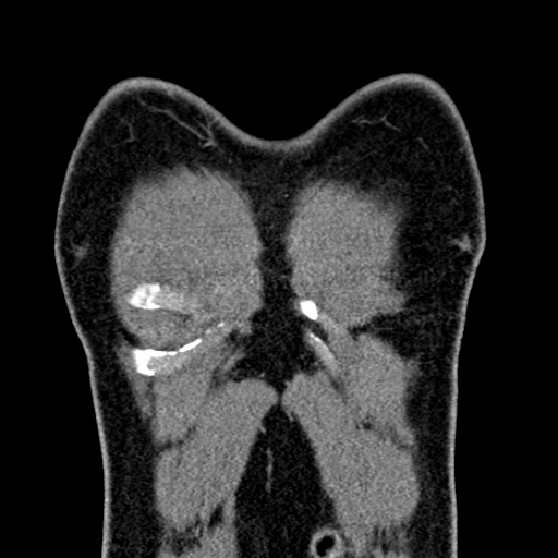 Apical lung mass mimic - neurogenic tumor (Radiopaedia 59918-67521 B 31).jpg