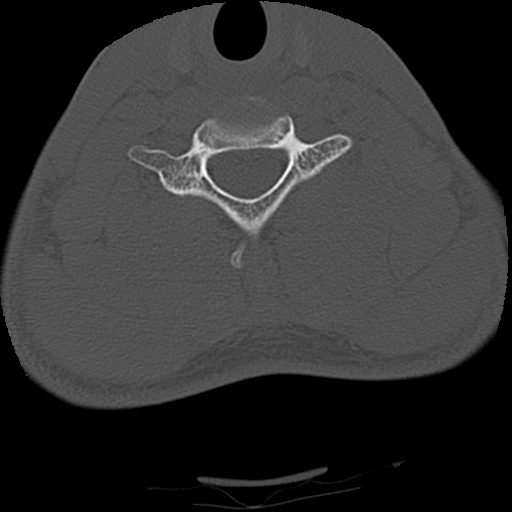 Apical pneumothorax on cervical spine CT (Radiopaedia 45343-49368 Axial bone window 66).jpg