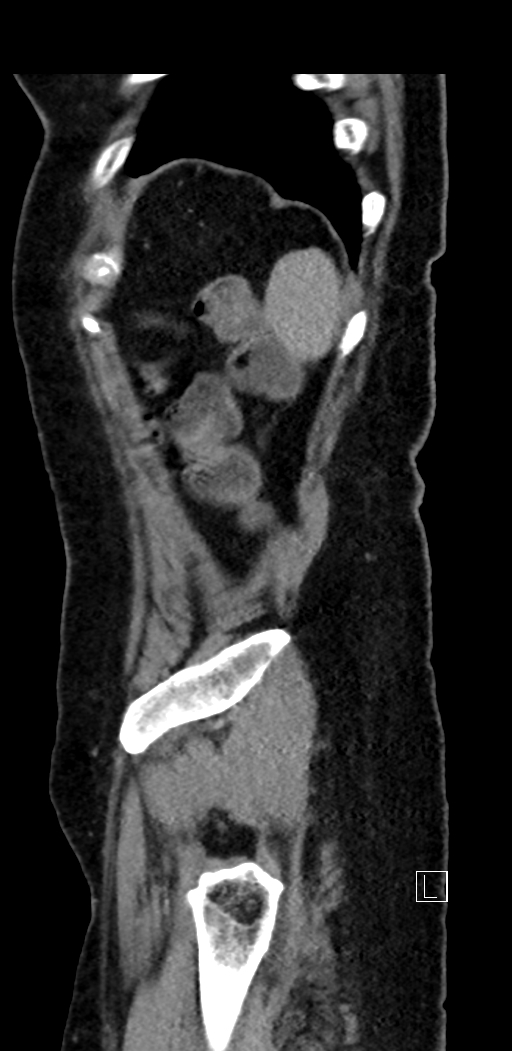 Appendiceal hemorrhage (Radiopaedia 70830-81025 Sagittal C+ delayed 99).jpg