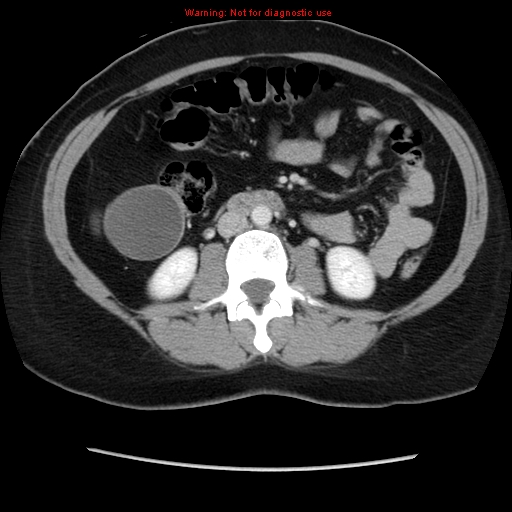 Appendiceal mucinous cystadenoma (Radiopaedia 8263-9111 Axial liver window 41).jpg