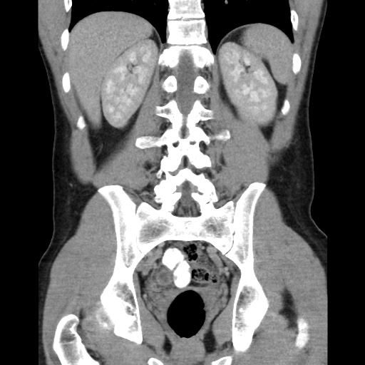 Appendicitis complicated by post-operative collection (Radiopaedia 35595-37113 B 39).jpg