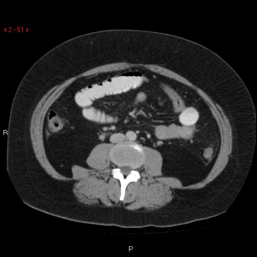 Appendicitis with microperforation- promontoric type (Radiopaedia 27268-27442 C 39).jpg
