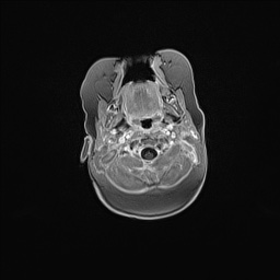 Aqueductal stenosis (Radiopaedia 73974-84802 Axial T1 C+ 27).jpg