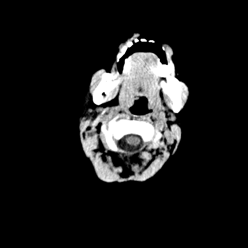 Arachnoid cyst-posterior fossa (Radiopaedia 88661-105370 Axial non-contrast 3).jpg