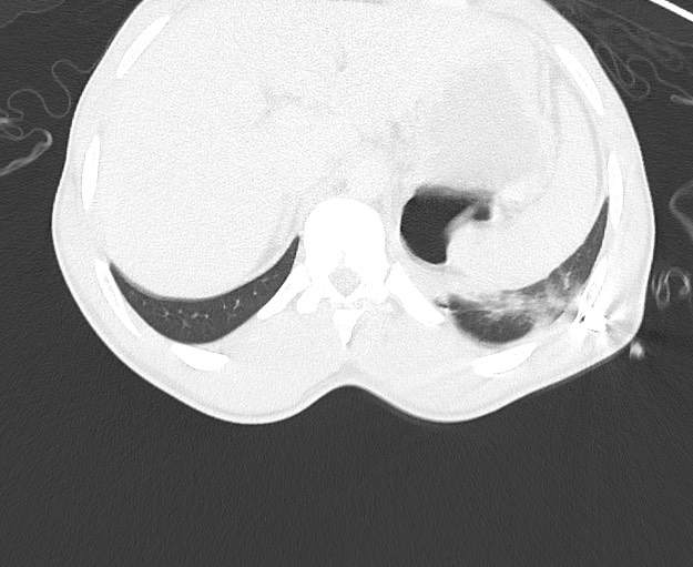 File:Arrow injury to the chest (Radiopaedia 75223-86321 Axial lung window 97).jpg