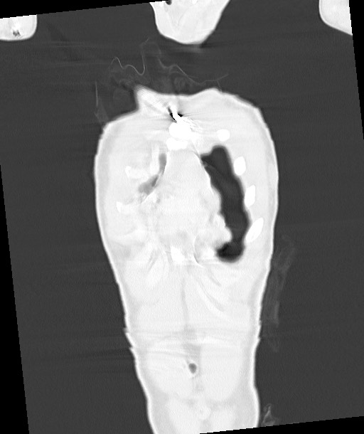 Arrow injury to the chest (Radiopaedia 85367-100975 Coronal lung window 41).jpg